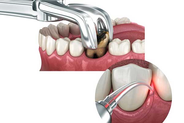 Chirurgia Dentale in Turchia