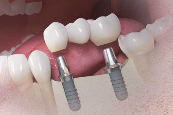 Impianti Dentali in Turchia