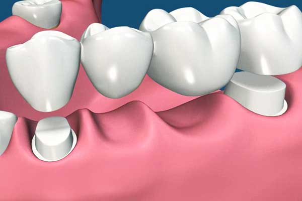 Ponti Dentali in Turchia