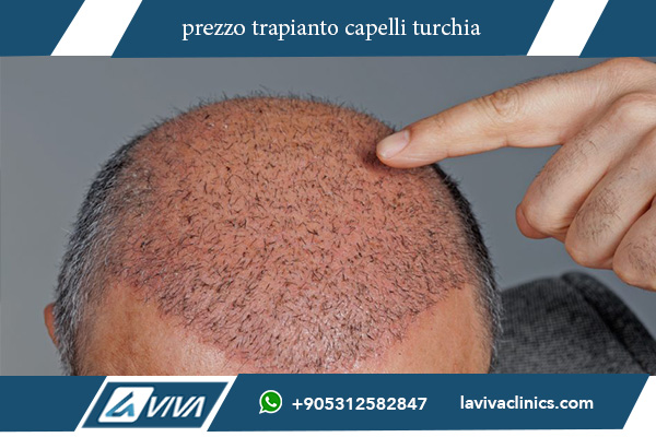 autotrapianto capelli turchia