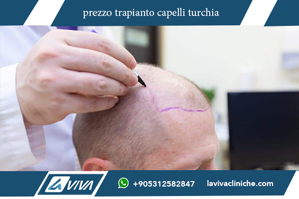 trapianto dei capelli in turchia