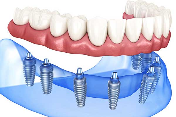 dentiera fissa in turchia