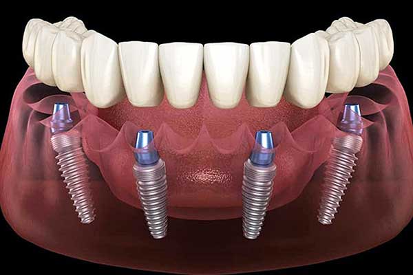 Impianti Dentali a Bocca Intera in Turchia