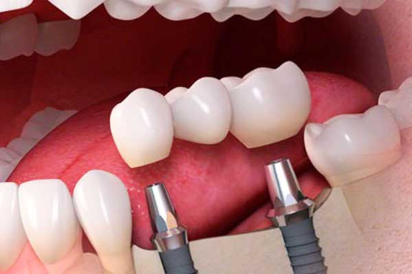 impianti dentali in turchia