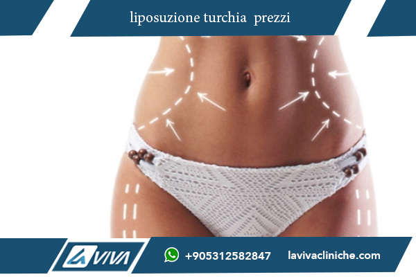 liposuzione turchia recensioni