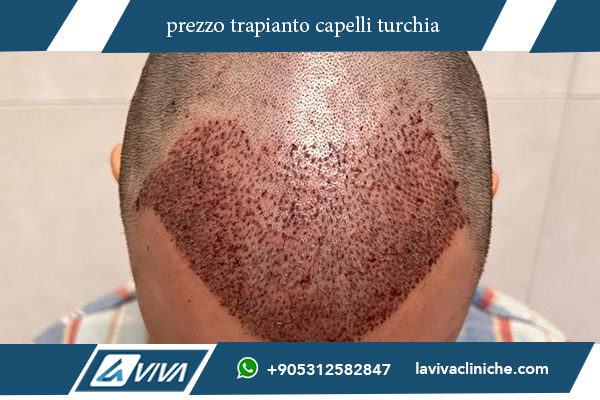 migliori cliniche trapianto capelli turchia