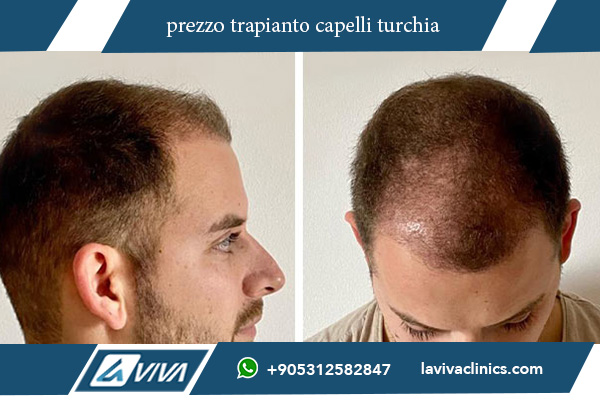 prezzo trapianto capelli turchia