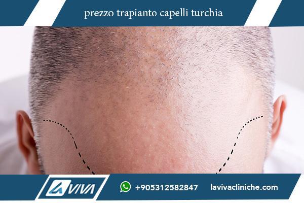 trapianti capelli turchia