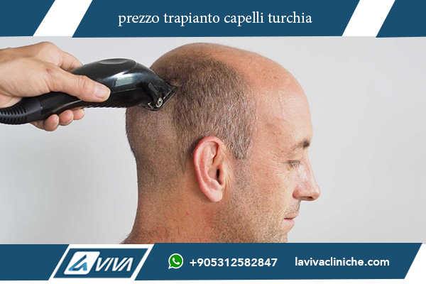 trapianto ,capelli, turchia, 1000 euro