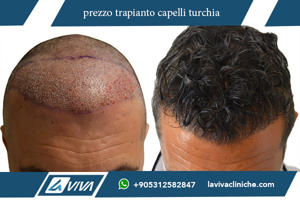 trapianto capelli turchia prima e dopo