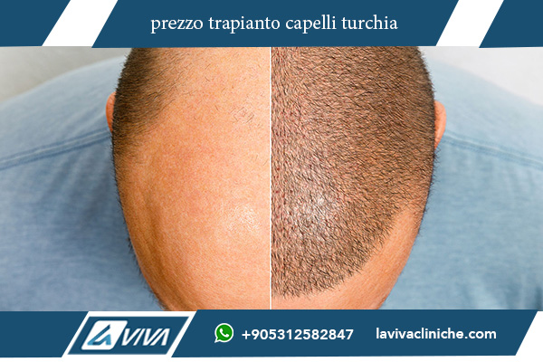 trapianto capelli turchia recensioni