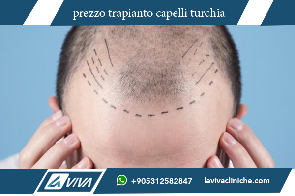 trapianto capelli turchia