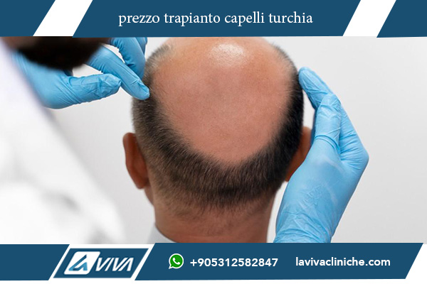 trapianto dei capelli turchia