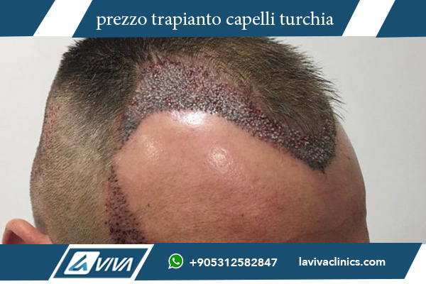 trapianto di capelli in turchia