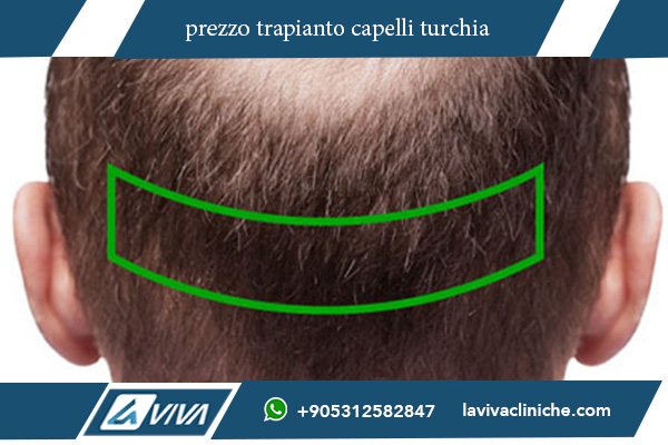 trapianto di capelli turchia