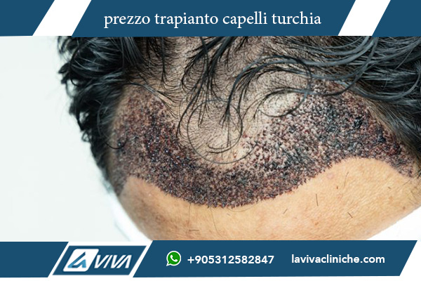 turchia trapianto capelli