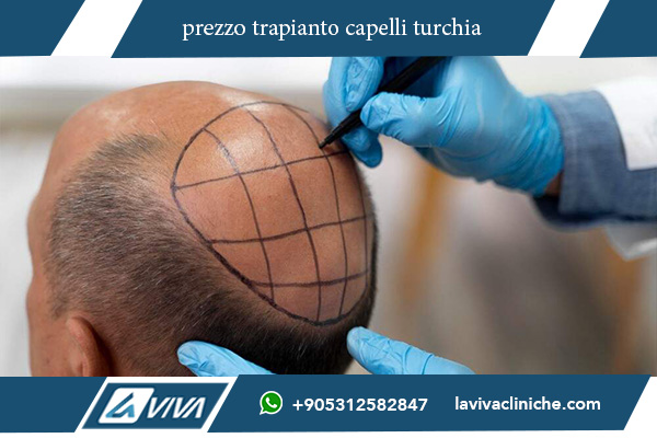 turchia trapianto di capelli