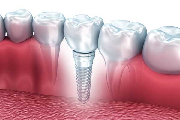 impianto dentale in zirconio prezzi