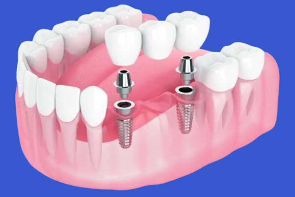 impianto dentale dura tutta la vita