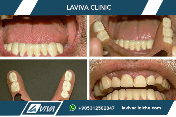 impianto dentale low cost, impianto dentale Turchia, prezzi impianto dentale, impianti dentali economici, faccette dentali Turchia, turismo dentale Turchia, dentista Turchia, migliori cliniche dentali Turchia, Laviva Clinic, Dr. Wahid Katkhuda, risparmio impianto dentale, qualità impianto dentale, costo impianto dentale, impianto dentale Straumann, All-on-4 Turchia, carico immediato impianto dentale, faccette dentali low cost, impianti dentali duraturi, trattamento dentale Turchia, cliniche dentali certificate, turismo sanitario Turchia, miglior dentista Turchia, impianti dentali sicuri, materiali impianto dentale, esperienza dentista Turchia, impianto dentale economico, dentista esperto Turchia