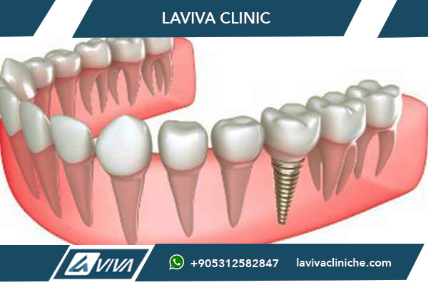 trattamenti dentali in Turchia, trattamenti dentali in Marocco, impianti dentali Turchia, impianti dentali Marocco, faccette dentali Turchia, faccette dentali Marocco, costi trattamenti dentali Turchia, costi trattamenti dentali Marocco, esperienza dentale Turchia, esperienza dentale Marocco, turismo dentale Turchia, turismo dentale Marocco, clinica dentale Turchia, clinica dentale Marocco, confronto costi dentali, perché scegliere la Turchia, Laviva Clinic, miglior dentista Turchia, sorriso perfetto Turchia, impianti dentali economici Turchia