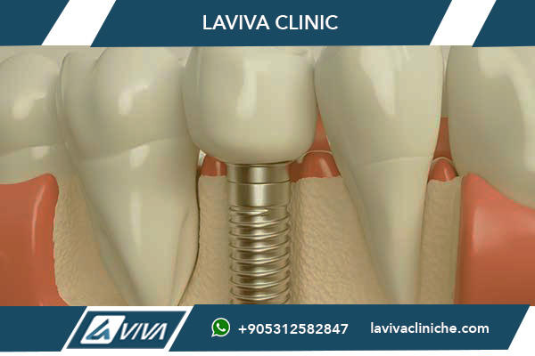 impianti dentali Turchia, impianti dentali Regno Unito, esperienze impianti dentali, costi impianti dentali, risparmio impianti dentali, turismo dentale Turchia, qualità cure dentali, Laviva Clinic, Dr. Wahid Katkhuda, impianti dentali economici, confronto prezzi impianti dentali, tecnologia dentale Turchia, pacchetti dentali completi, sorriso perfetto Turchia, turismo medico Turchia