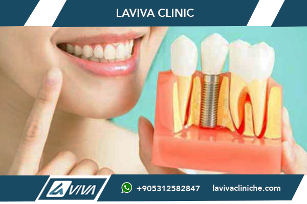 impianti dentali Turchia, garanzia impianti dentali, costo impianti dentali Turchia, migliori impianti dentali, impianti dentali economici, impianti dentali di qualità, turismo dentale Turchia, clinica dentale Turchia, LAVIVA CLINIC, Dr. Wahid Katkhuda, prezzi impianti dentali, impianti dentali a vita, vantaggi impianti dentali Turchia, tecnologie impianti dentali, faccette dentali Turchia, impianti dentali sicuri, impianti dentali economici Europa, risparmio impianti dentali, sorriso perfetto Turchia, trattamento dentale all'estero