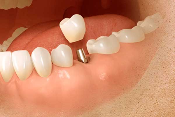 impianto dentale istanbul, impianti dentali turchia, dentista istanbul, costo impianto dentale turchia, cliniche dentali istanbul, turismo dentale turchia, impianti all on 4 istanbul, denti fissi turchia, prezzi impianti dentali istanbul, odontoiatria estetica istanbul