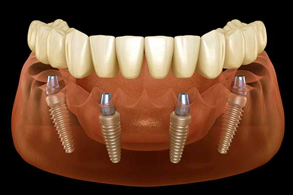 dentista italiano in Turchia, impianti dentali Turchia, faccette dentali Turchia, clinica dentale Istanbul, turismo dentale Turchia, dentista economico Turchia, odontoiatria estetica Turchia, denti fissi in Turchia, Invisalign Turchia, impianto dentale low cost