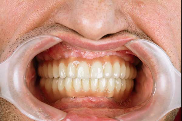 impianti dentali turchia, prezzi impianti dentali, dentista in turchia, costo impianto dentale, turismo dentale turchia, all on 4 turchia, all on 6 turchia, cliniche dentali turchia, dentisti specializzati turchia, implantologia turchia