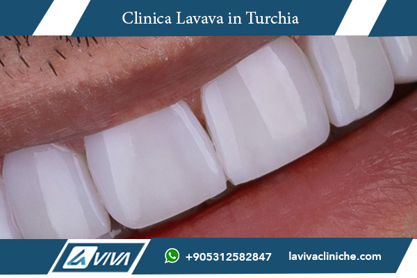 faccette dentali, faccette dentali in Turchia, costo faccette dentali, estetica dentale, turismo dentale, dentisti in Turchia, miglior sorriso, risparmio dentale, odontoiatria estetica, faccette in ceramica, faccette Emax, cliniche dentali Turchia, prezzi faccette dentali, faccette zirconio, estetica dentale in Turchia, dentisti esperti, faccette dentali confronto, miglior dentista in Turchia, faccette dentali Italia vs Turchia