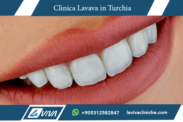 faccette dentali, estetica dentale, faccette in ceramica, faccette in zirconia, faccette Emax, faccette dentali Turchia, faccette dentali Marocco, impianti dentali, costo faccette dentali, turismo dentale, dentisti in Turchia, miglior dentista, Laviva Clinic, estetica dentale Turchia, odontoiatria estetica, sorridere meglio, prezzi faccette dentali, risparmiare sui denti, qualità dentale, trattamento faccette dentali