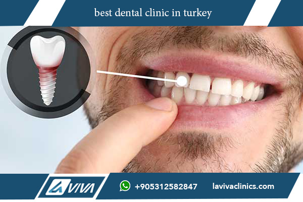 Impianti Dentali Turchia Treatment