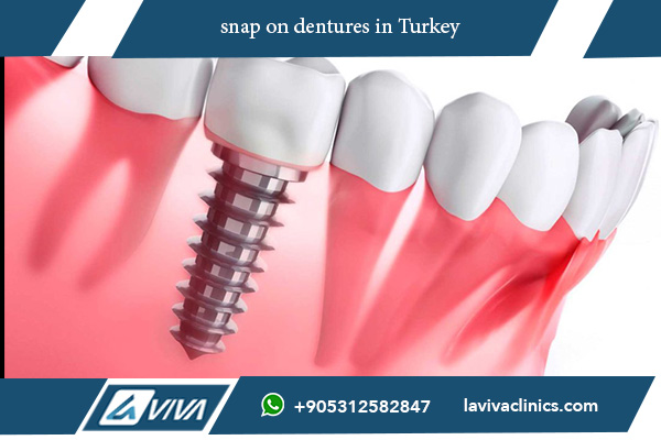 Impianti Dentali in Turchia