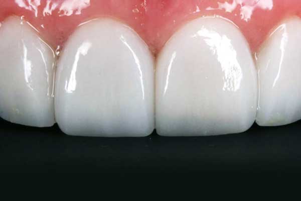 Hollywood Smile Tyrkiet Pris