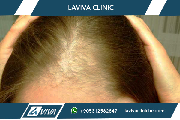 Guida Completa al Costo Trapianto Capelli Istanbul 2025: Prezzi, Tecniche e Tutto Ciò Che Devi Sapere