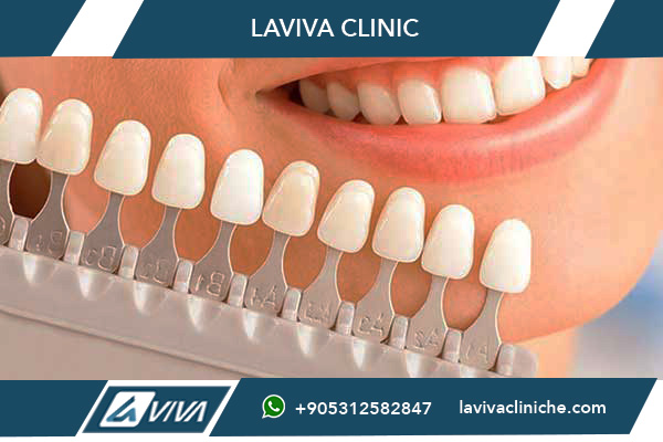 Prezzo Faccette Dentali Istanbul