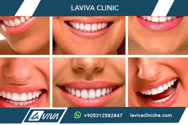 Quanto Costa Impianto Dentale in Turchia