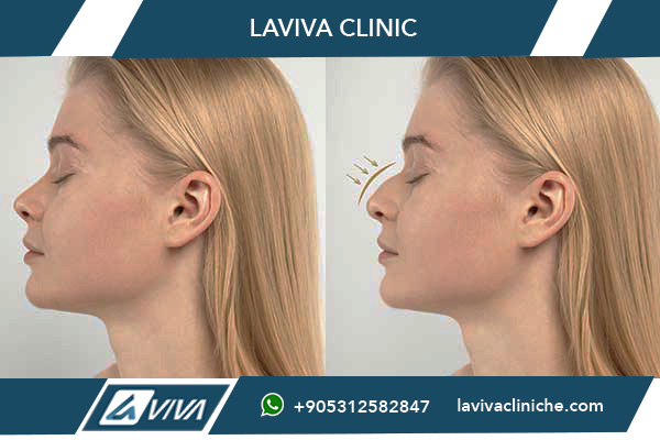 Costo Rinoplastica Turchia