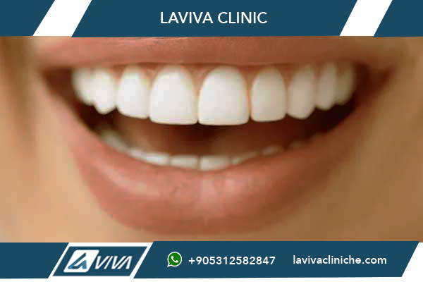 Sorriso di Hollywood Turchia 2026