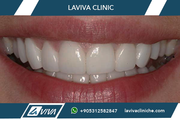 All-on-4 Istanbul: La Soluzione Definitiva per un Sorriso Perfetto nel 2026