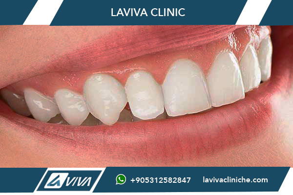 Protesi Dentale Fissa Turchia: La Guida Completa 2026 per Risparmiare Fino all'80%