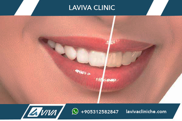 Ponte Dentale Zirconio Istanbul: La Soluzione Perfetta per un Sorriso Naturale nel 2026