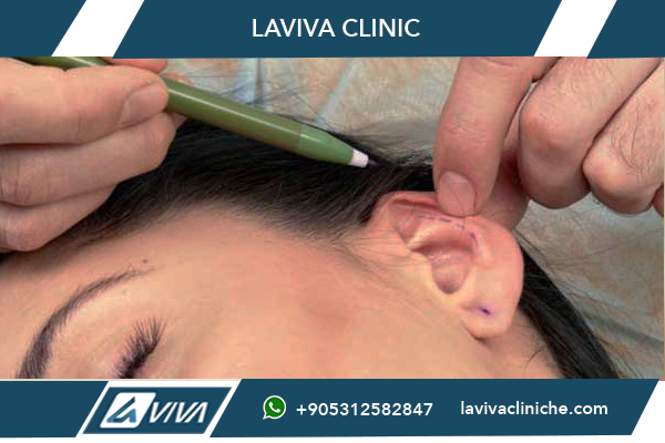 Otoplastica a Istanbul